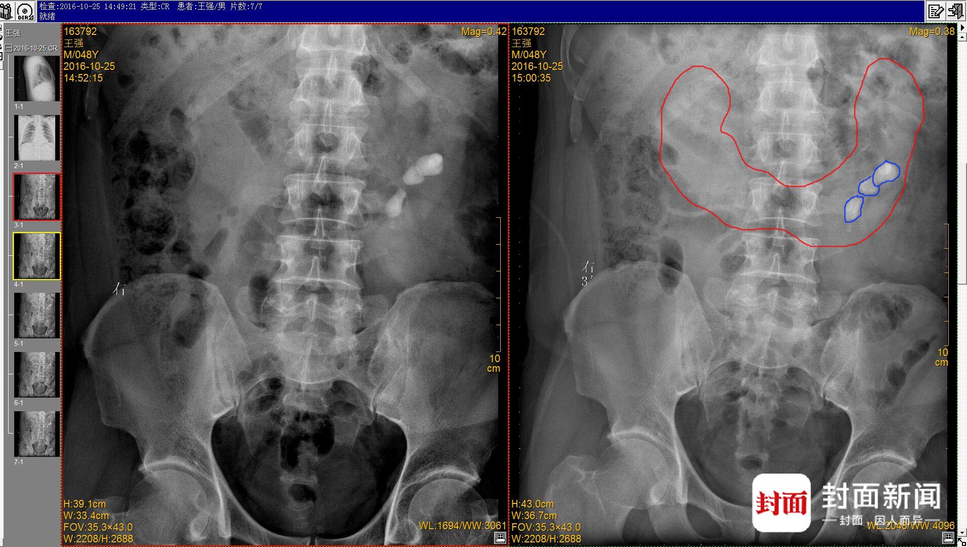 王先生术前x光示意图(红色为马蹄肾基本轮廓,蓝色为结石轮廓)