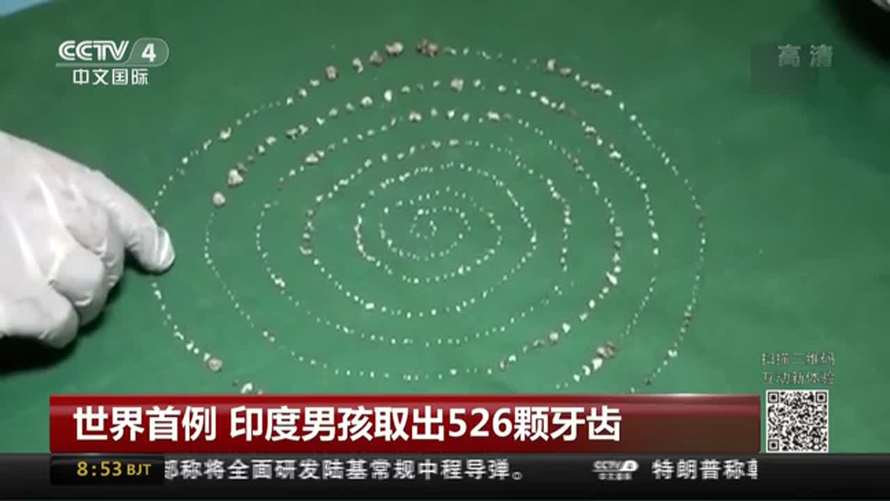 世界首例!印度一男孩嘴里取出526颗牙齿
