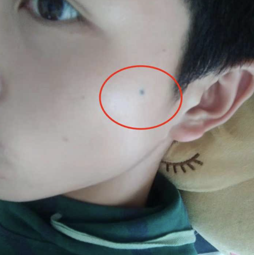 左边脸颊有一颗天蓝色痣(如上图).是否报案:是,杭州滨江公安分局