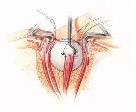 眼科医生眼球摘除手术是如何进行的?