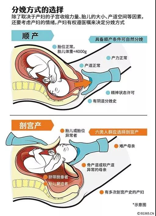 无痛分娩真的不痛?产妇都可以做?